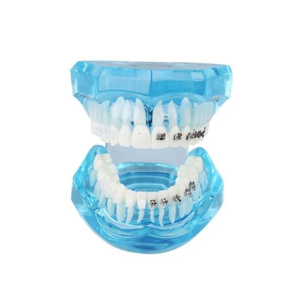 BRACKETTE ORTHODONTIC SYSTEM BLEU