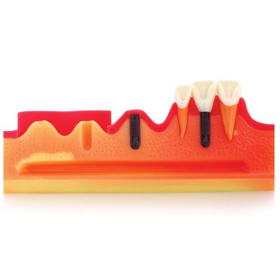 Modèle de démonstration implant