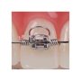 AMERICAN ORTHODONTICS / Warren Torquing Spring