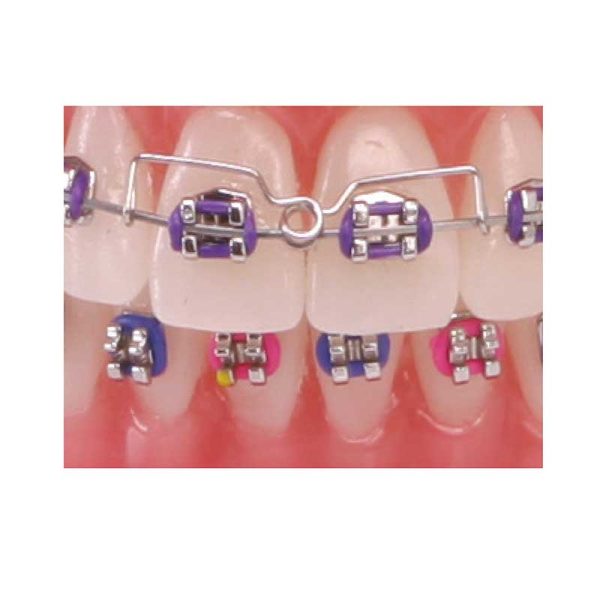 AMERICAN ORTHODONTICS / Torquing Spring